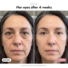 ÖVIE Eye Treatment with Micro-Vibration Wand 3