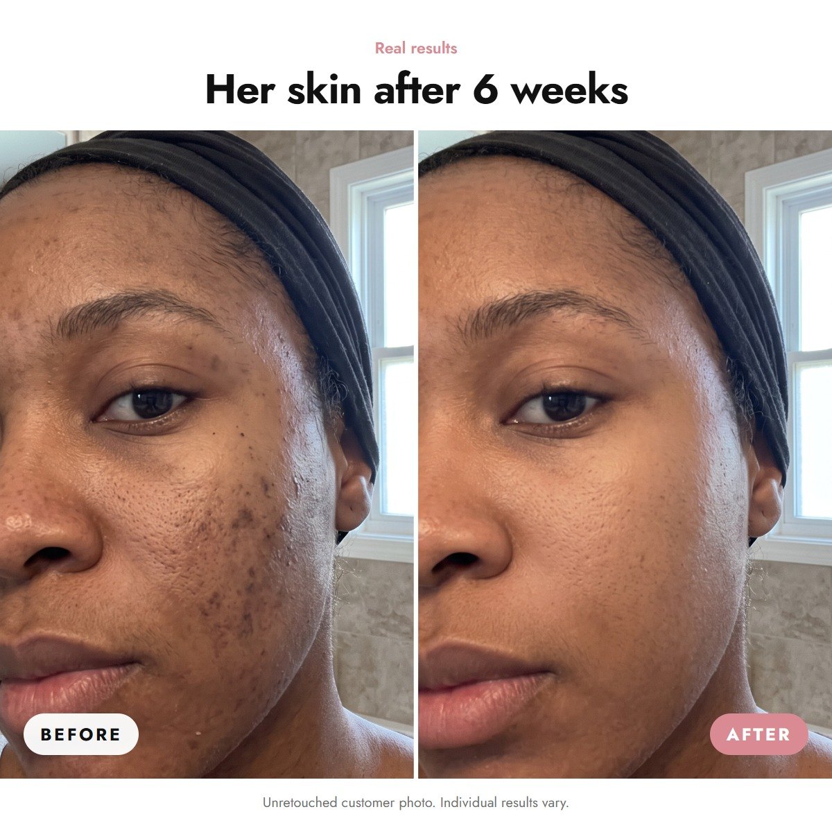 ÖVIE Niacinamide Serum 3