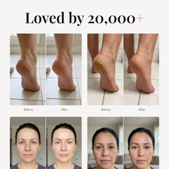 ÖVIE Deep Repair Heel & Elbow Stick 6
