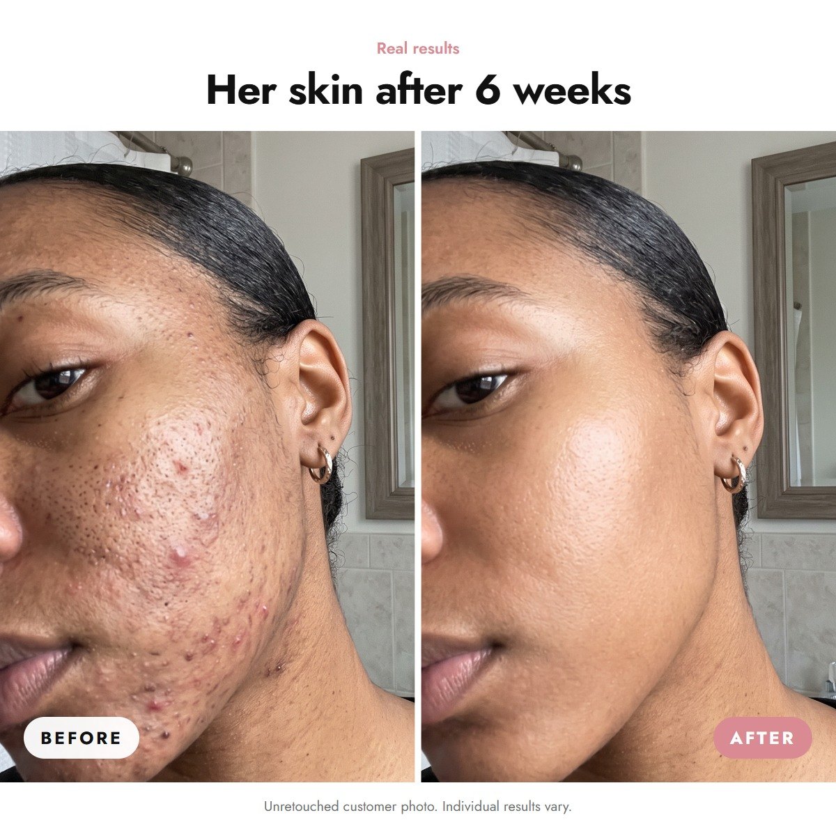ÖVIE Salicylic Acid Exfoliant 3