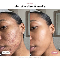 ÖVIE Salicylic Acid Exfoliant 3